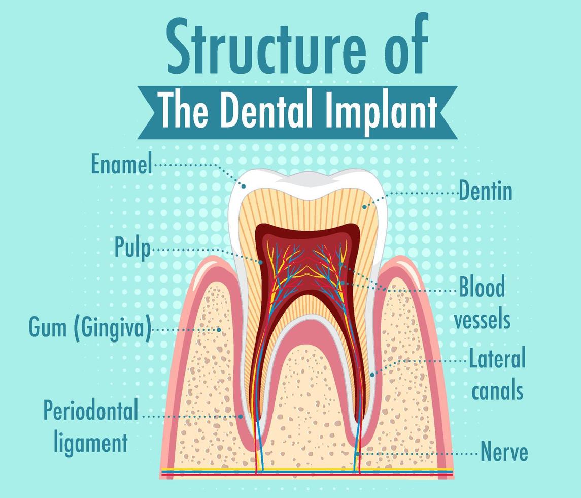 infografica dell'essere umano nella struttura dell'impianto dentale vettore