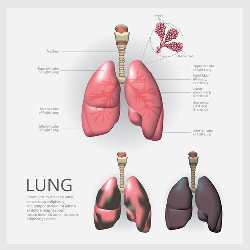 Polmone con il dettaglio e l&#39;illustrazione di vettore del cancro polmonare