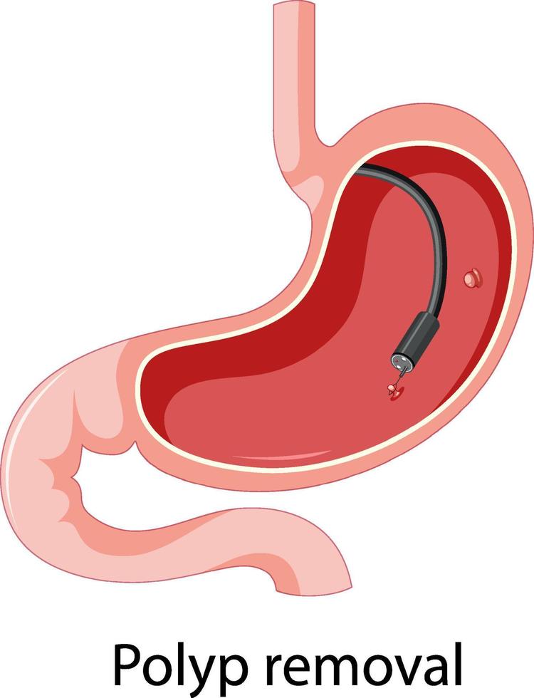 diagramma che mostra la rimozione del polipo nell'uomo vettore