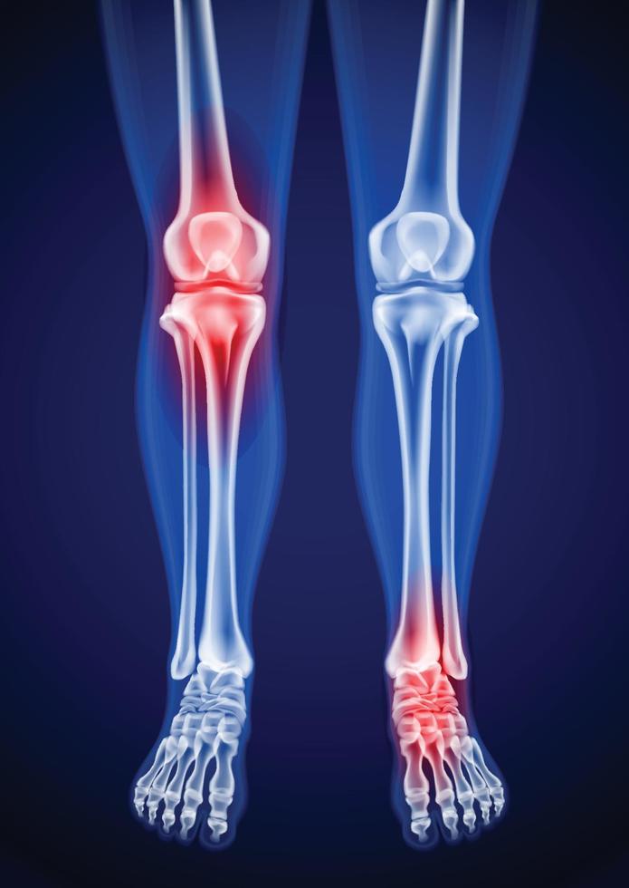 immagini a raggi x di cosce, ginocchia e piedi umani. mostra i punti dolenti in rosso. vettore