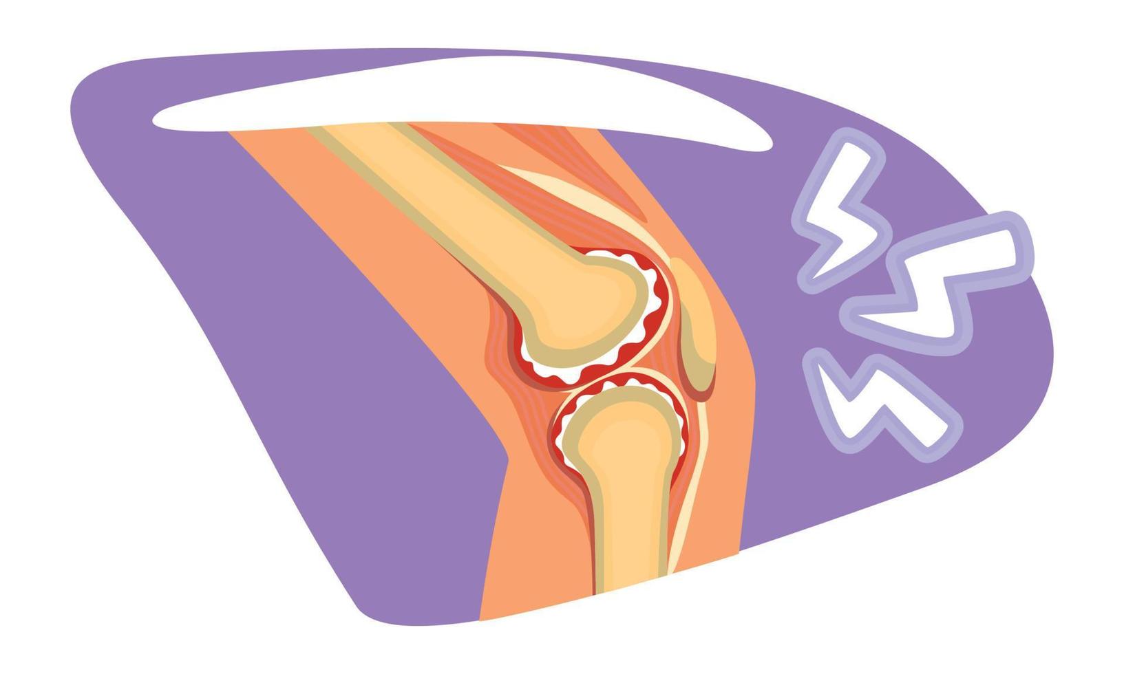 illustrazione isolata del vettore 2d del dolore al ginocchio
