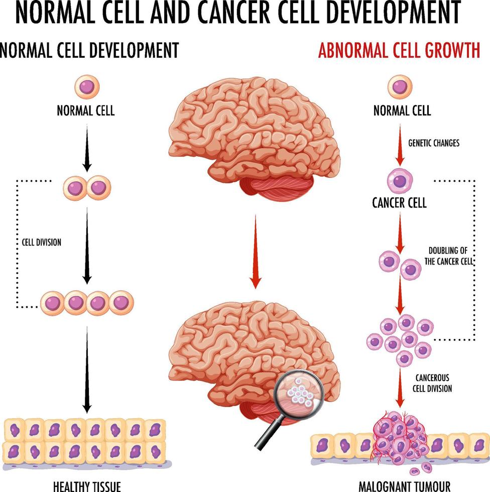 diagramma che mostra il cervello umano e il cancro vettore