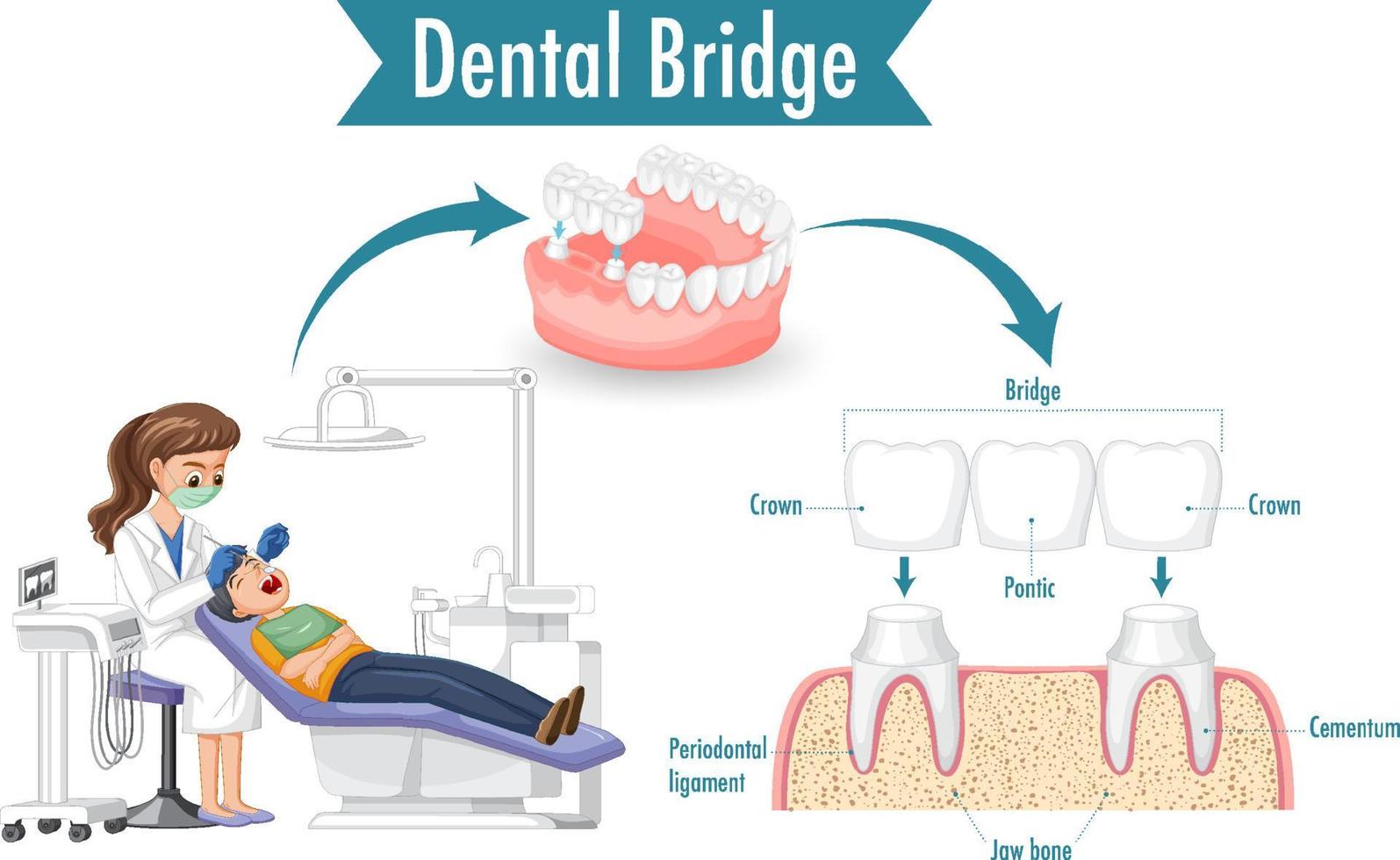 infografica dell'essere umano nel ponte dentale su sfondo bianco vettore