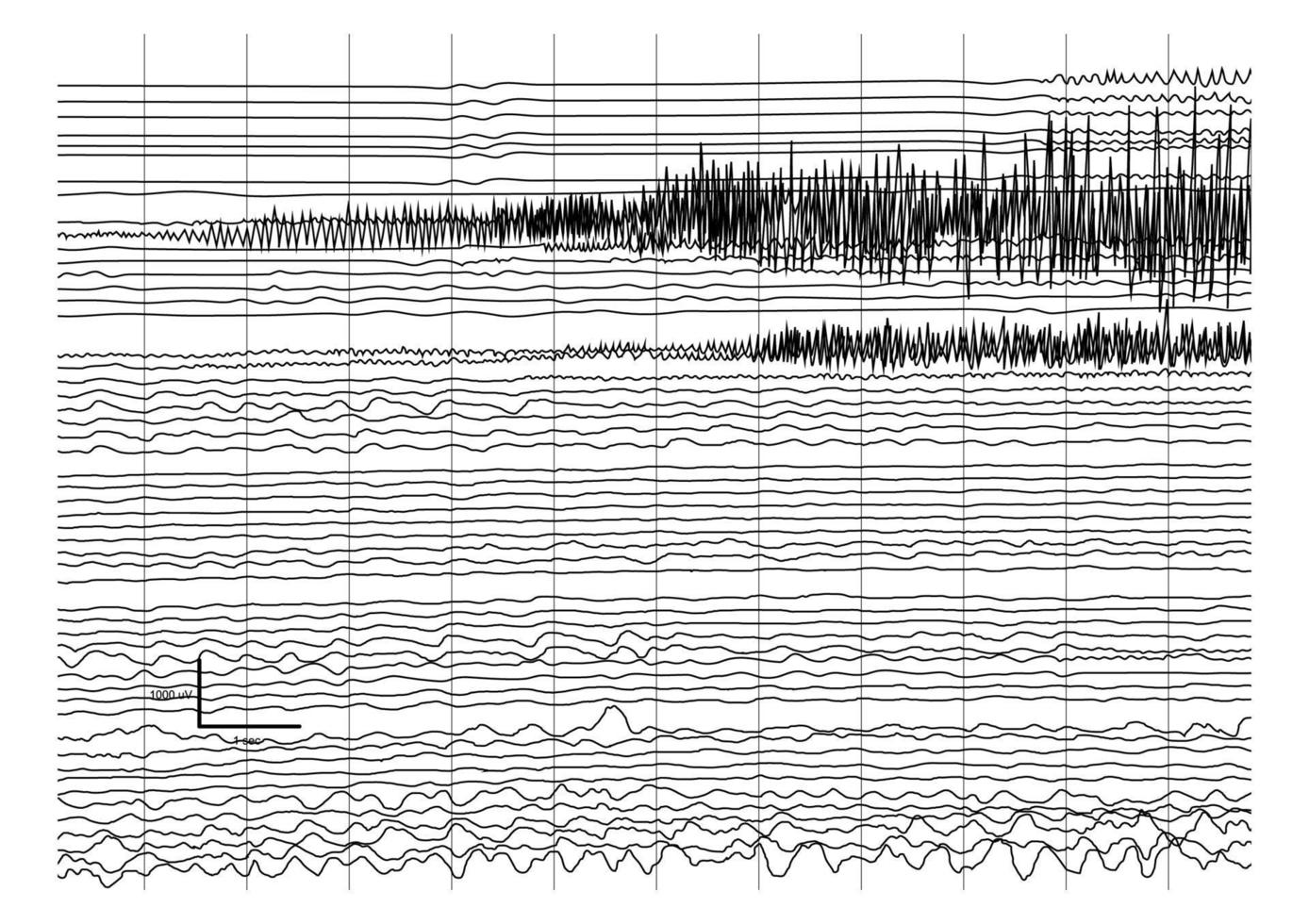 illustrazione vettoriale della registrazione ictal eeg durante il sequestro.