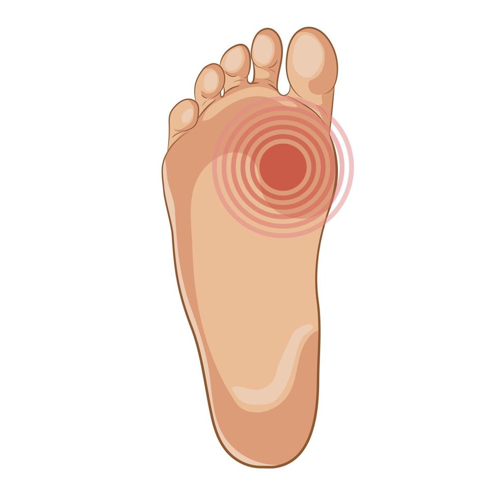 illustrazione della suola del piede. concetto di dolore. vettore
