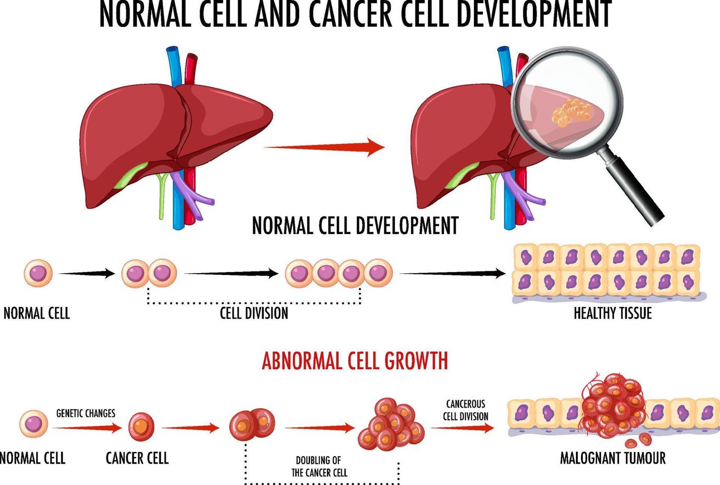 diagramma che mostra il processo di sviluppo del cancro vettore