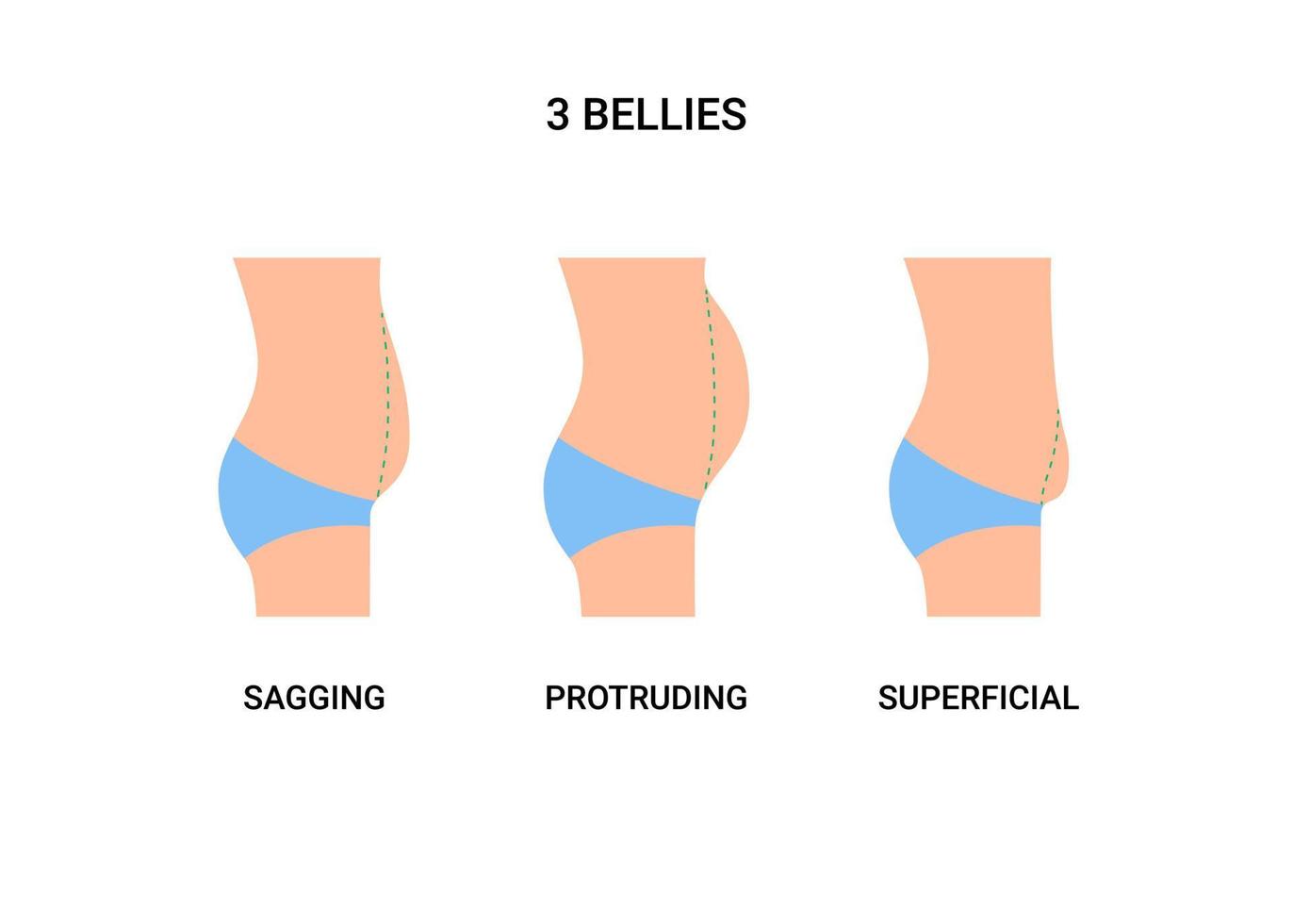 tipi pance del corpo umano, pancia grande con sovrappeso. pancia cadente, sporgente e superficiale. perdita di peso, riduzione del volume della pancia, chirurgia plastica. illustrazione vettoriale