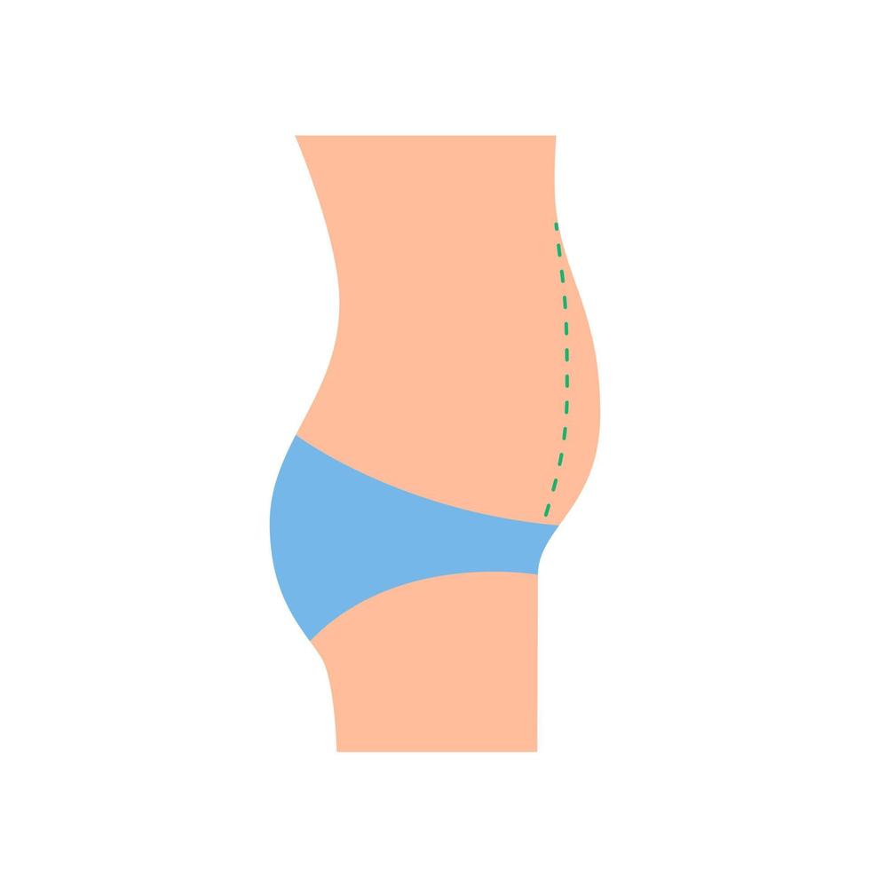 pancia sporgente della donna, correzione grande pancia grassa, addominoplastica. sovrappeso. perdita di peso, riduzione del volume della figura del corpo, chirurgia plastica. illustrazione vettoriale vista laterale