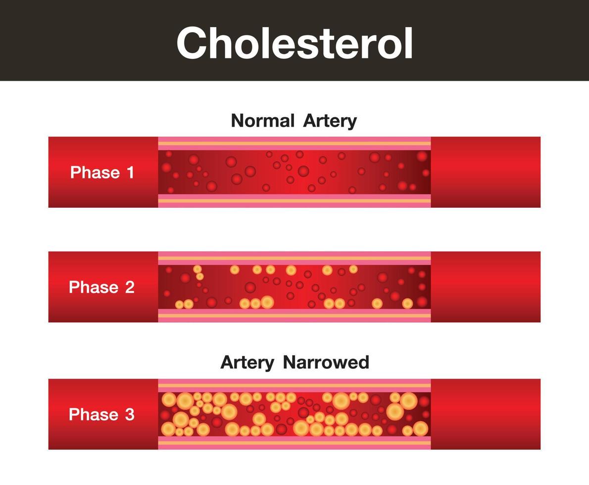 colesterolo nell'arteria, rischio per la salute, disegno vettoriale