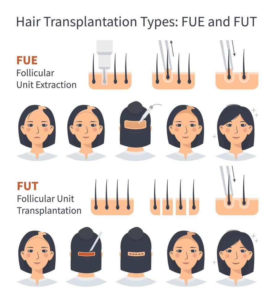 trapianto di capelli femminili fue e fut, fasi di estrazione dell'unità follicolare. trattamento di calvizie, alopecia e caduta dei capelli. infografica medica vettoriale, cuoio capelluto della testa della donna. macchina per strisce e innesti. vettore