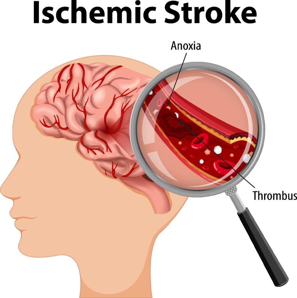 umano con ictus ischemico vettore