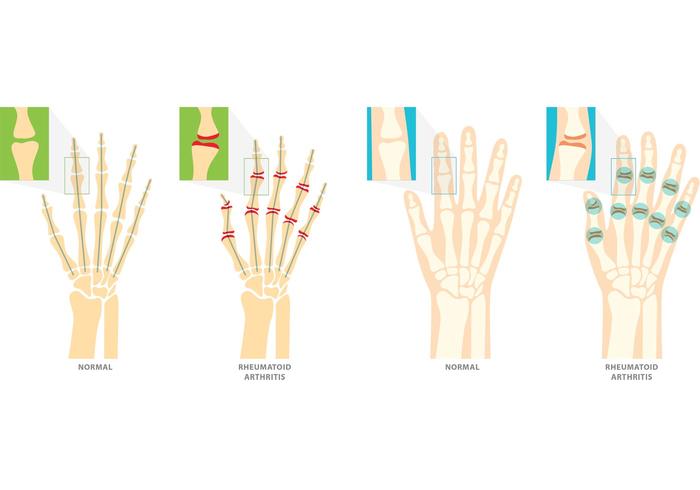 Simboli vettoriali artrite reumatoide