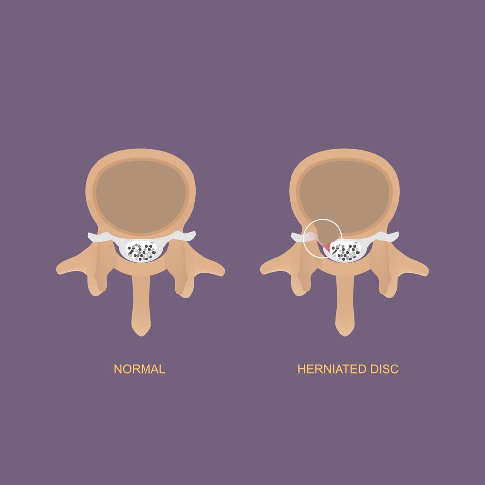 illustrazione dimostrazione di ernia del disco lombare umana vettore