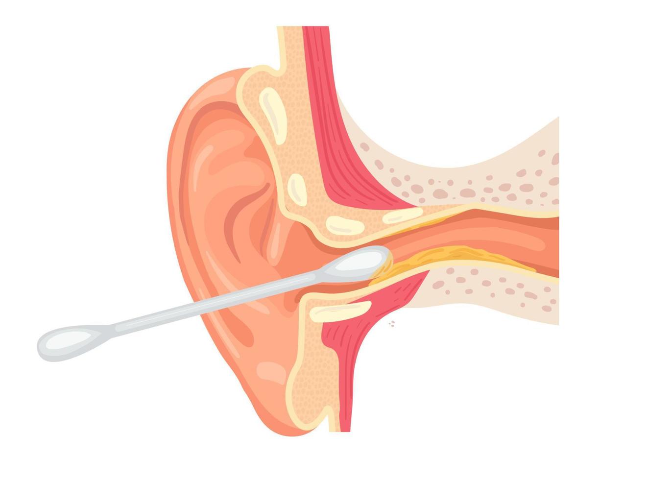 illustrazione della pulizia del condotto uditivo con un batuffolo di cotone. sezione dell'orecchio con cerume. uso scorretto di un batuffolo di cotone. vettore