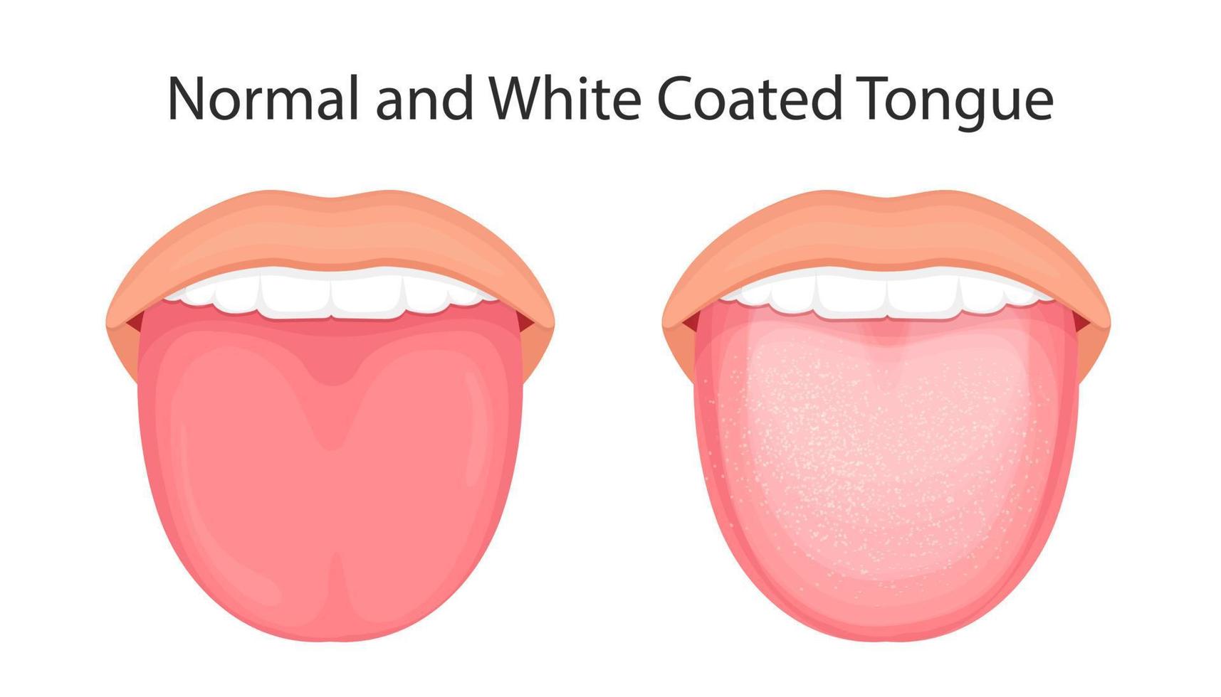 anatomia del cavo orale. illustrazione vettoriale della lingua con rivestimento bianco.