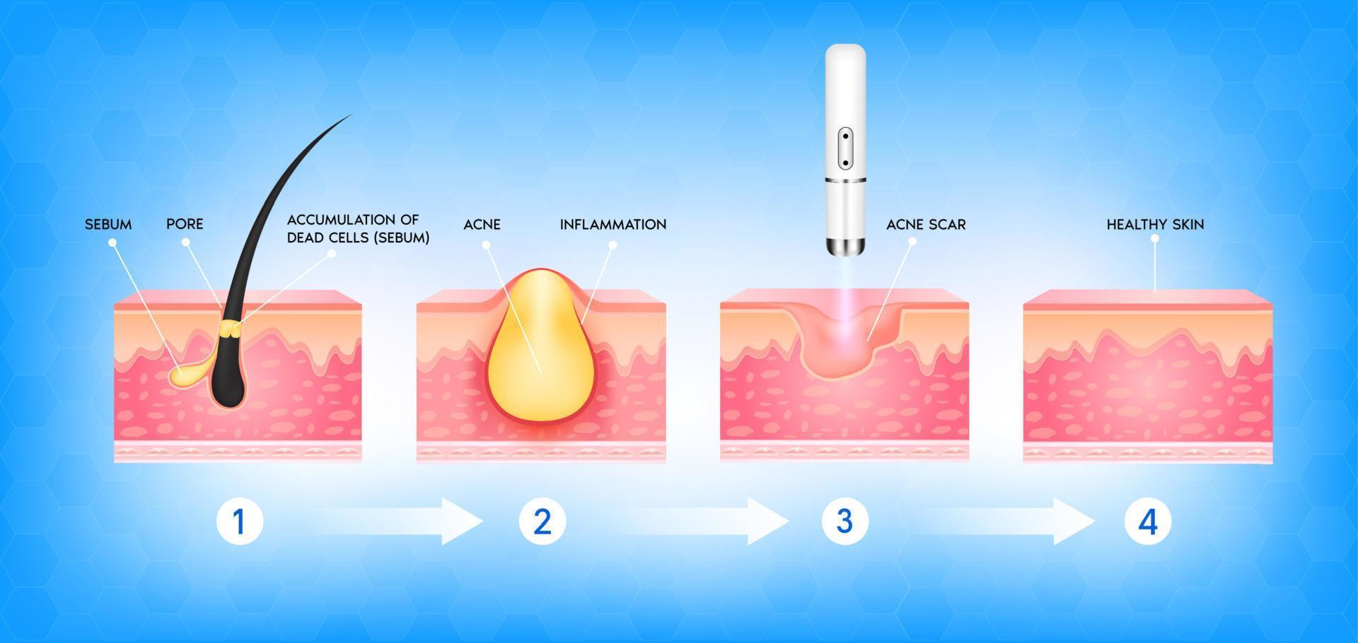 formazione di acne o brufolo cutaneo. l'accumulo di cellule morte il sebo nei pori ostruiti favorisce la crescita dei batteri. trattamento laser vascolare per cicatrici da acne. concetto di cura della pelle di bellezza medica. vettore 3d.