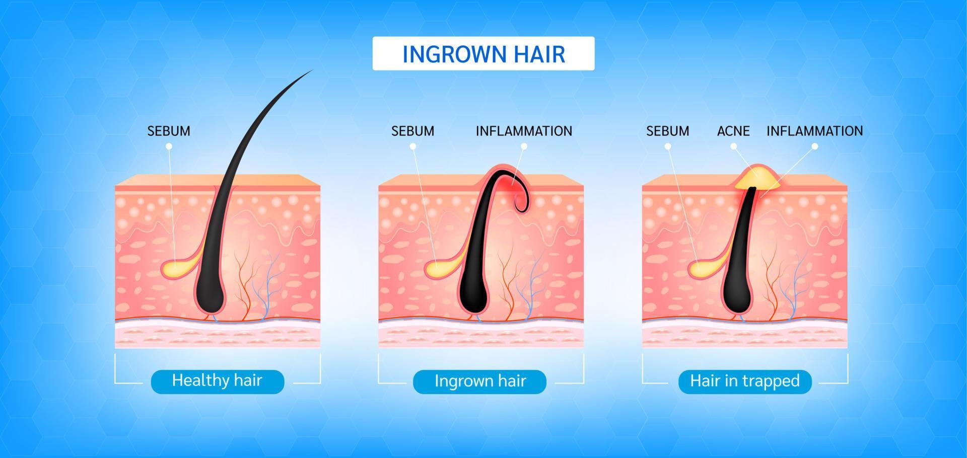 peli incarniti. i capelli sono ricresciuti sulla superficie della pelle dopo la rasatura. formazione di acne o brufolo cutaneo. infografica di anatomia di capelli e pelle. illustrazione vettoriale 3d.