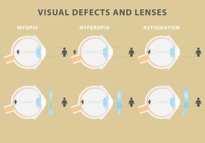 Vector difetti visivi e lenti