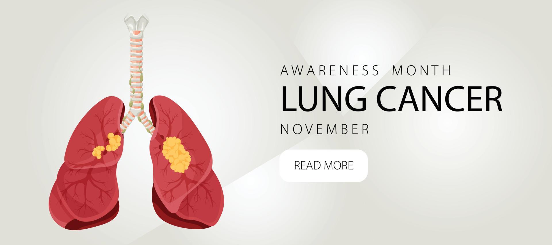 banner informativo sul cancro ai polmoni. modello di progettazione per siti Web, riviste. illustrazione vettoriale in stile cartone animato.