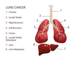 diagramma malattia del cancro del polmone. concetto di malattia degli organi interni umani. illustrazione vettoriale, stile cartone animato. vettore