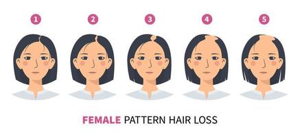 stadi di caduta dei capelli, modello femminile di alopecia androgenetica fphl. passi di calvizie infografica vettoriale in uno stile piatto con una donna.