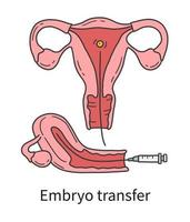 trasferimento di embrioni nell'utero di una donna durante la fecondazione in vitro vettore