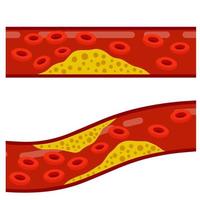 colesterolo nel sangue. vene e arterie con grasso. vettore