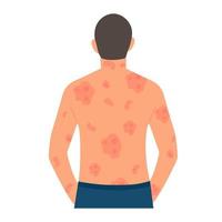 dermatologico pelle patologia, psoriasi.allergica prurito, pelle infiammazione, arrossamento e irritazione.guttata psoriasi.pelle problemi.isolato, vettore. vettore