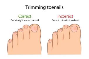 corretta e improprio taglio di il unghia del piede. medico illustrazione vettore