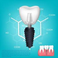 vettore realistico dente. strutturale elementi di un' dentale impiantare. Infografica per medico manifesto.