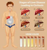 fasi del diagramma educativo di malattia del fegato vettore
