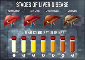 diagramma educativo della malattia del fegato vettore