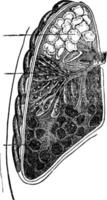 polmone con polmonite, Vintage ▾ illustrazione vettore