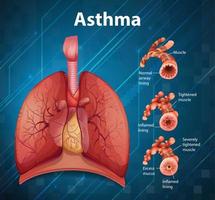 confronto tra grafico polmone sano e polmone asmatico vettore