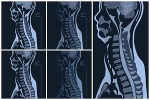 magnetico risonanza l'imaging di il cervicale colonna vertebrale colonna vertebrale. spondilosi e spinale cordone compressione. vettore