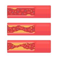 coronario arterie con accumulato Grasso nel il corpo vettore