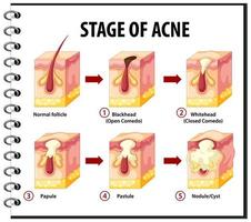 fasi dell'anatomia della pelle dell'acne vettore