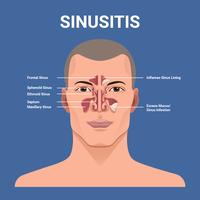 Illustrazione vettoriale di sinusite