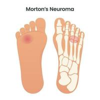 mortons neuroma medico educativo vettore illustrazione grafico