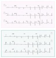 cuore cardiogramma grafico vettore. impostato salutare cuore ritmo, ischemia, infarto. vitalità battito cardiaco, cuore elettrocardiogramma, pulse linea vettore