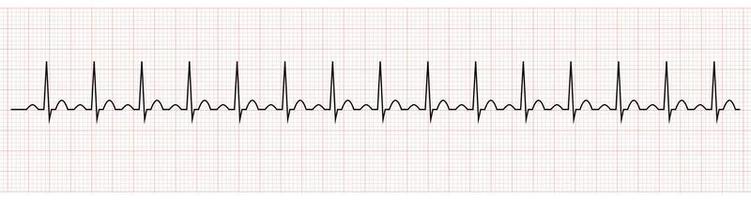 ekg mostrando seno tachicardia di paziente vettore