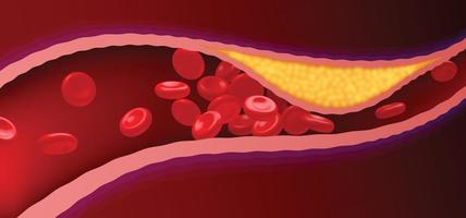 arterie con grasso ostruito che causa coaguli di sangue. vettore