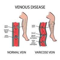 varicose vene venoso malattia di umano medicina formazione scolastica vettore