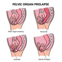 pelvico organo prolasso in modo vario formazione scolastica schema vettore impostato