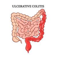 ulcerosa colite intestini medicina anatomia vettore schema