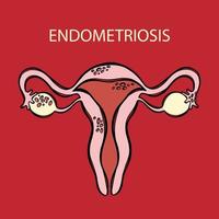 endometriosi femmina riproduttore sistema medicina formazione scolastica vettore