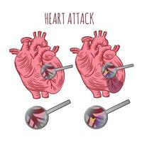 cuore attacco aterosclerosi medicina formazione scolastica vettore schema