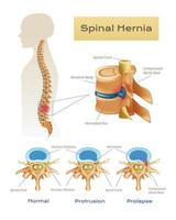 anatomia spinale ernia infografica vettore