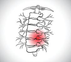 l'immagine dell'ernia del disco, può causare un forte dolore alla schiena che può portare alla paralisi vettore