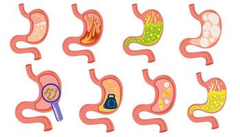 stomaco malattie impostare. gonfiore stomaco dolore, digestivo tratto dolore pienezza pesantezza stomaco, acido bruciore di stomaco processi indigestione duodeno riflusso. vuoto e pieno stomaco. vettore illustrazione